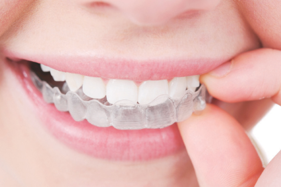 ماذا تعرف عن تقويم الأسنان الشفاف Alghad