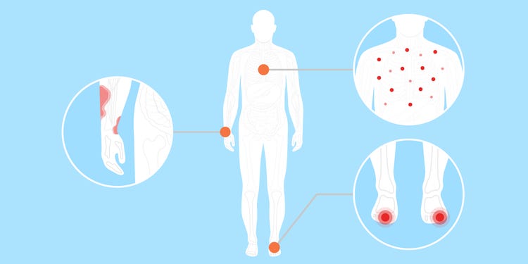 هناك خمس حالات جلدية يمكن ربطها بفيروس كورونا.